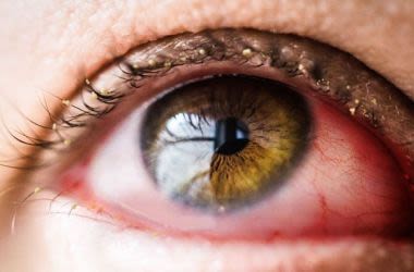 Closeup of an eye with conjunctivitis