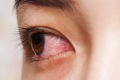 患有结膜炎的眼睛特写。