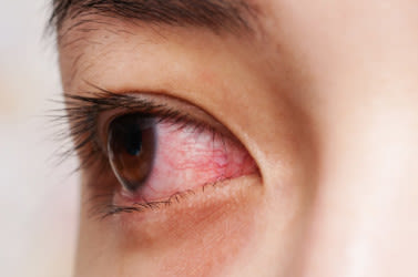 A closeup of an eye with conjunctivitis.