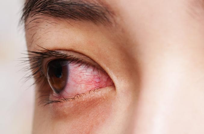 A closeup of an eye with conjunctivitis.