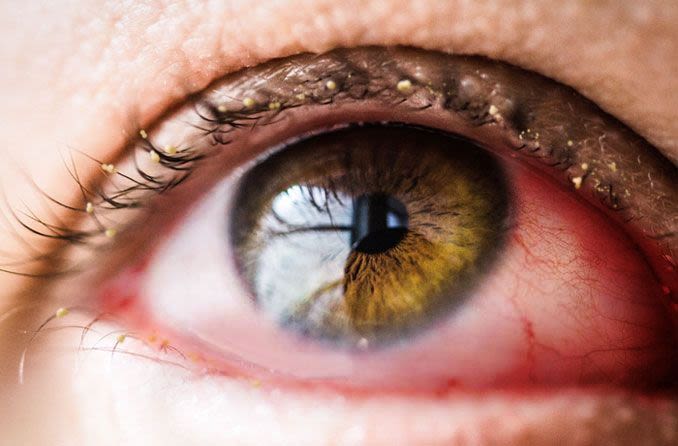 Primer plano de un ojo con conjuntivitis