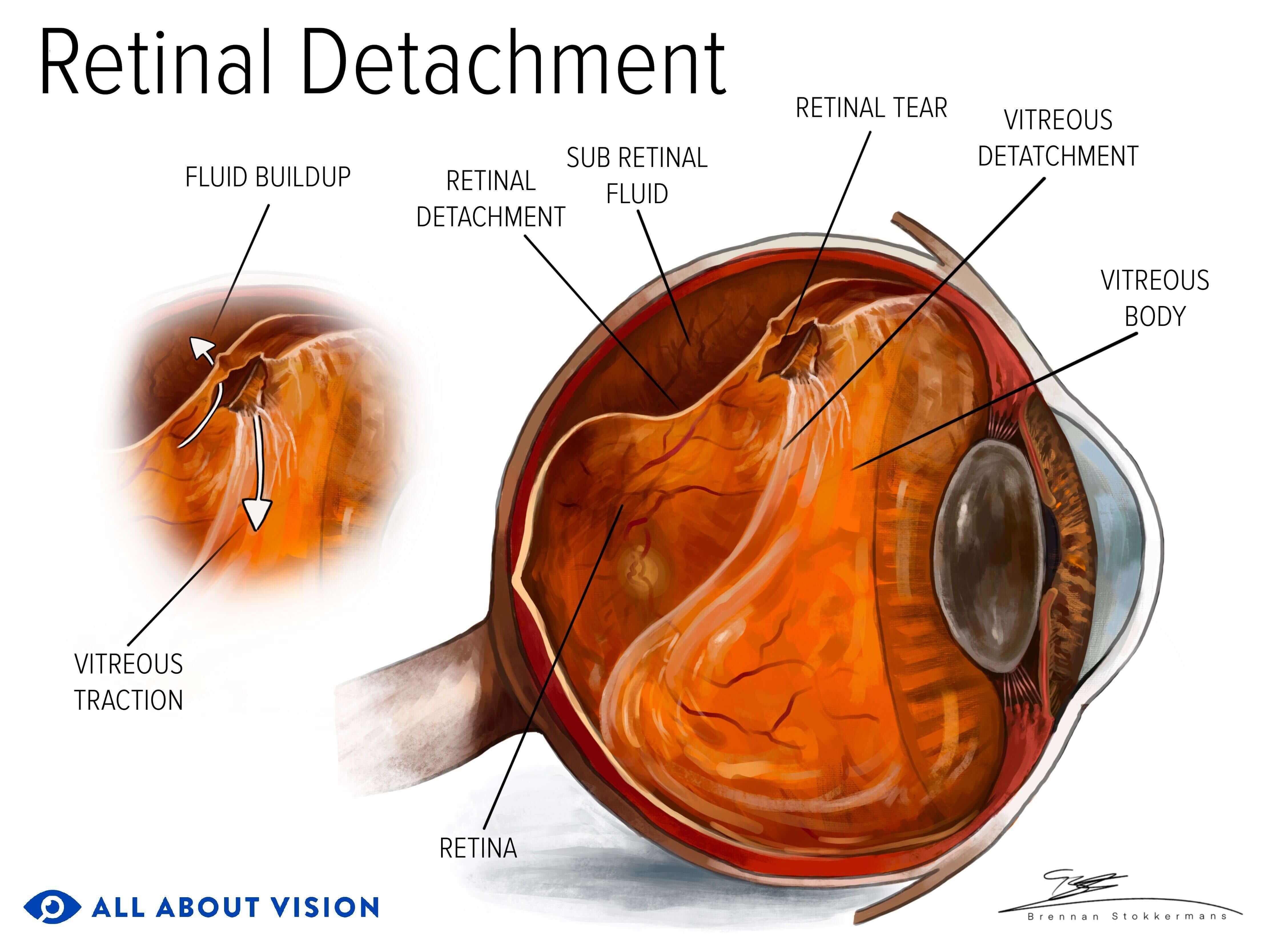 illustration of a detached retina