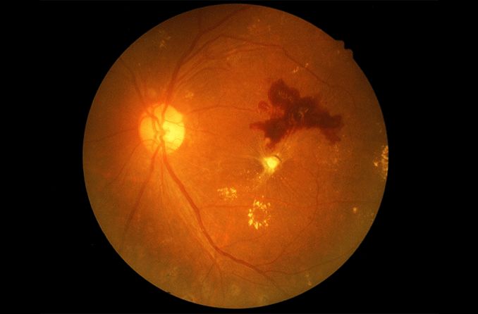 retinal hemorrhage