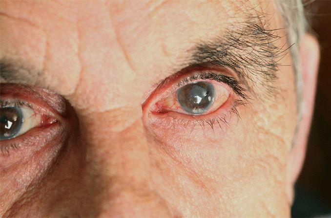 closeup of elderly man with cortical cataracts