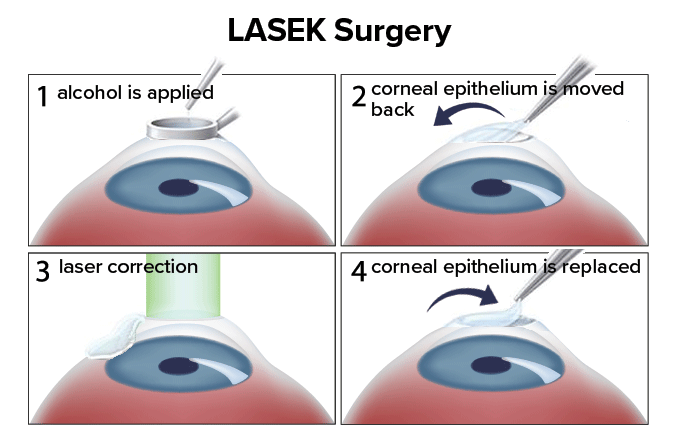 Guide To Lasik Eye And Vision Surgery All About Vision 