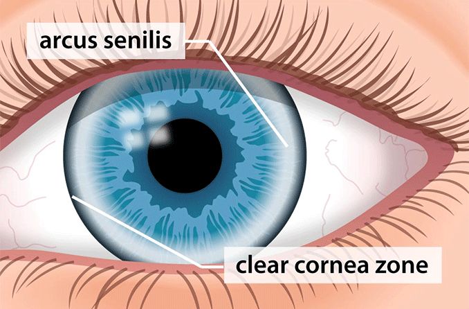 illustration of an eyeball with arcus senilis