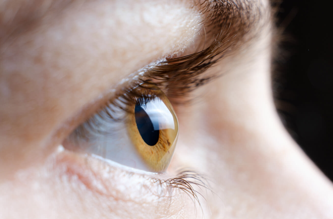 Macro photo of the human eye with Corneal Ectasia.