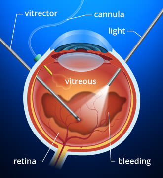 diabetic retinopathy treatment injection