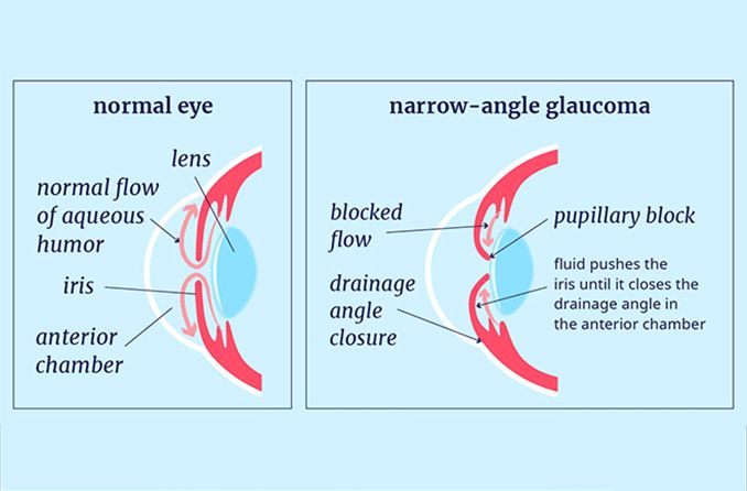 illustration of a regular eye vs eye with narrow angle glaucoma