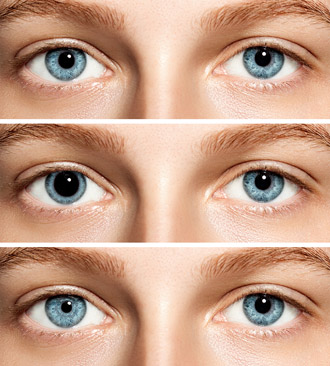 anisocoria definition