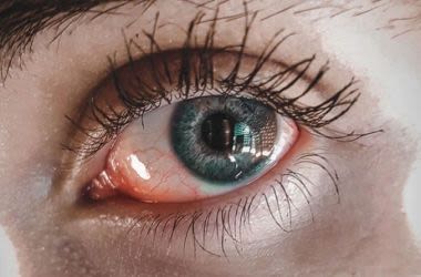 Uveitis Causes Symptoms And Pictures