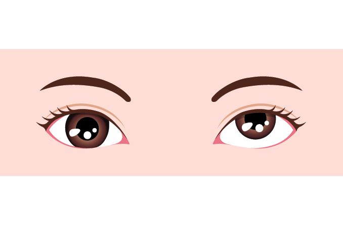 Strabismus, Crossed Eyes: Symptoms, Causes & Treatment