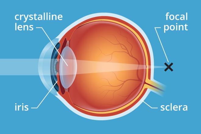 Presbyopia Symptoms Treatment Definition