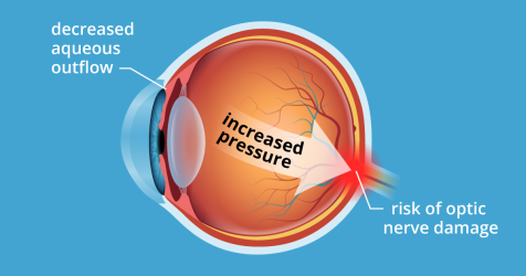 Retina Damage Chart