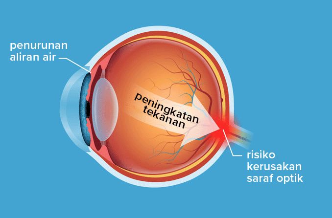 Ilustrasi diagram kondisi hipertensi okular