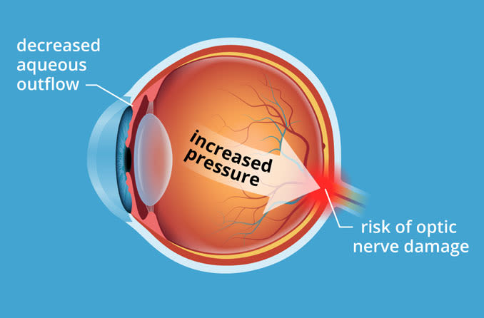illustration of ocular hypertension condition
