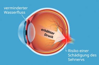 Diagrammdarstellung von erhöhten Augeninnendruck
