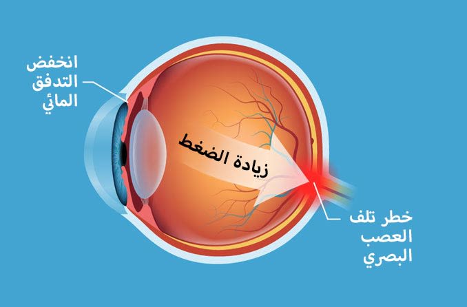 رسم توضيحي لحالة ارتفاع ضغط الدم في العين