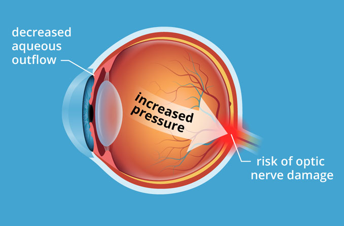 high eye pressure after retina surgery