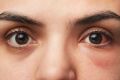 一个妇女结膜炎(红眼)的特写。