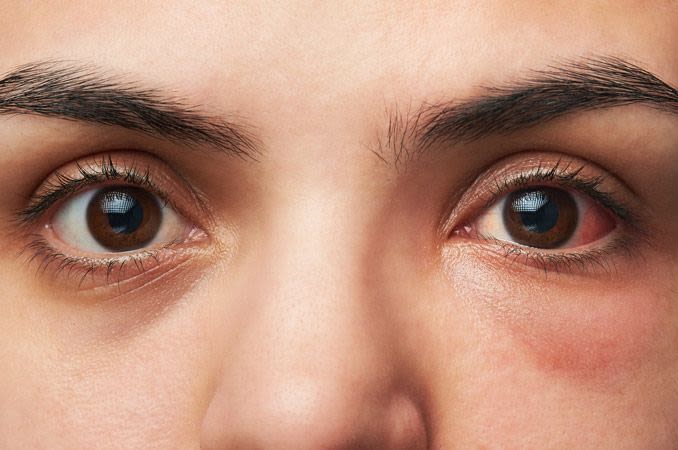 一个妇女的特写镜头有结膜炎（桃红色眼睛）的。