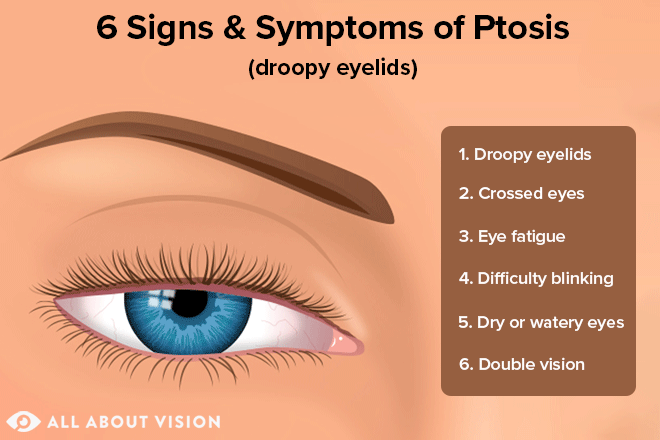 Ptosis Symptoms 660x440 