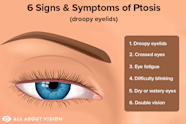 Droopy Eyelid Images Infoupdate
