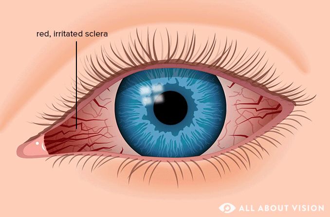 illustration of red eyes (inflamed and irritated sclera)