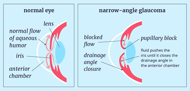 Narrow-angle glaucoma: Causes, symptoms and treatment Narrow-angle glaucoma: Causes, symptoms and treatment