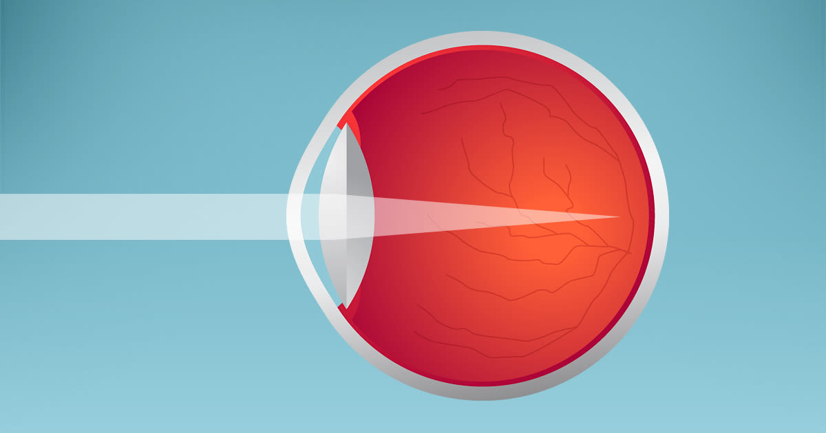 illustration of myopia, which causes nearsightedness