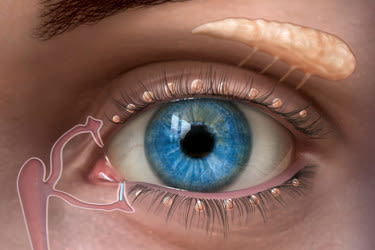plugs punctal tear ojo lacrimal glands eyelid duct lagrimales contactlenzen ojos seco ducts lagrimal oogontsteking glndulas devices cornea oog inserted
