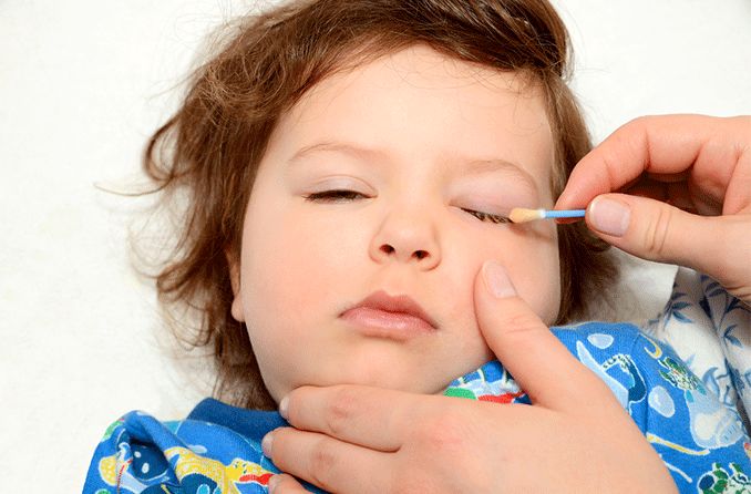 child with goopy eyes cleaning lids with a Q-tip