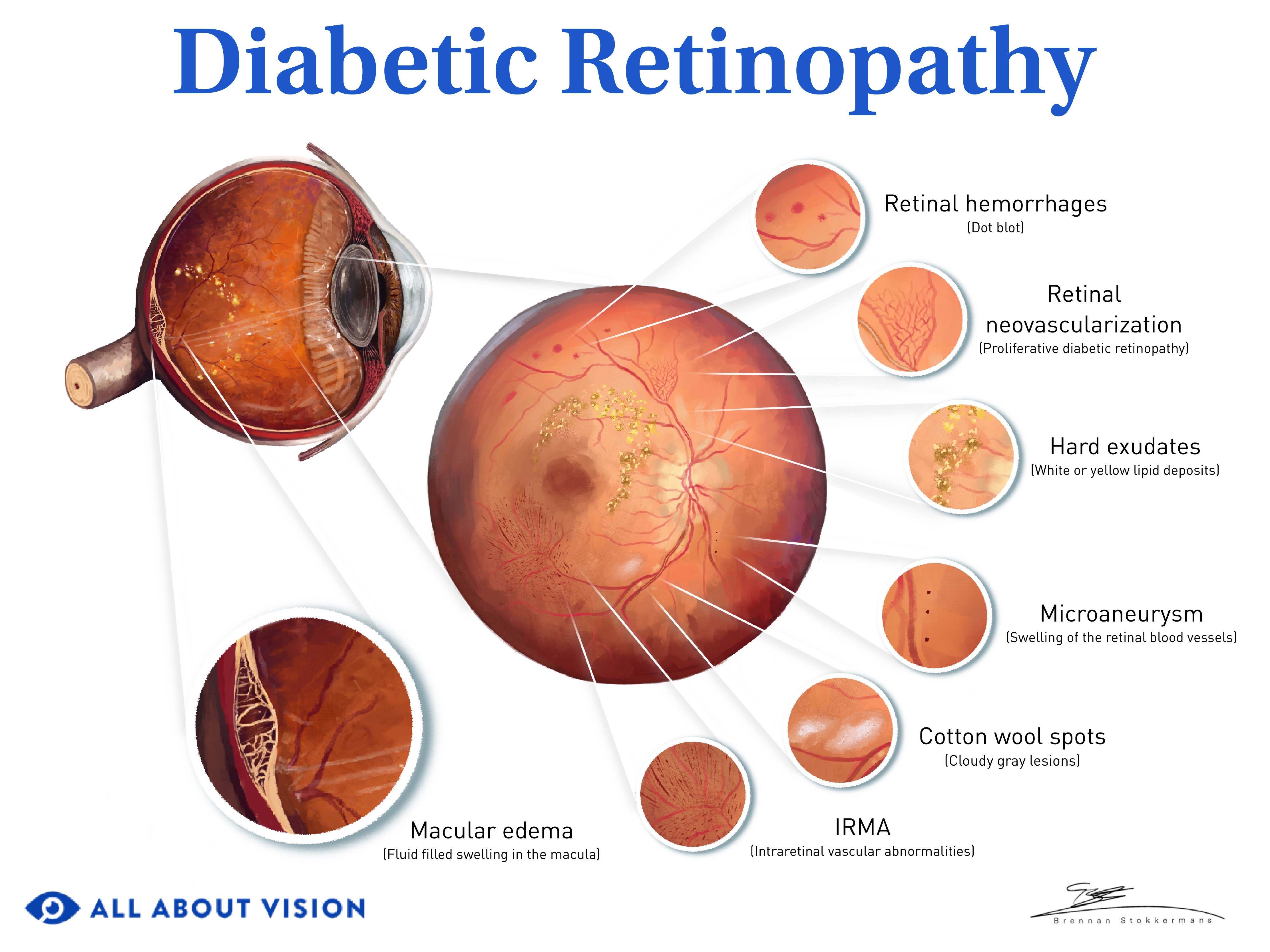 presentation of diabetic macular edema