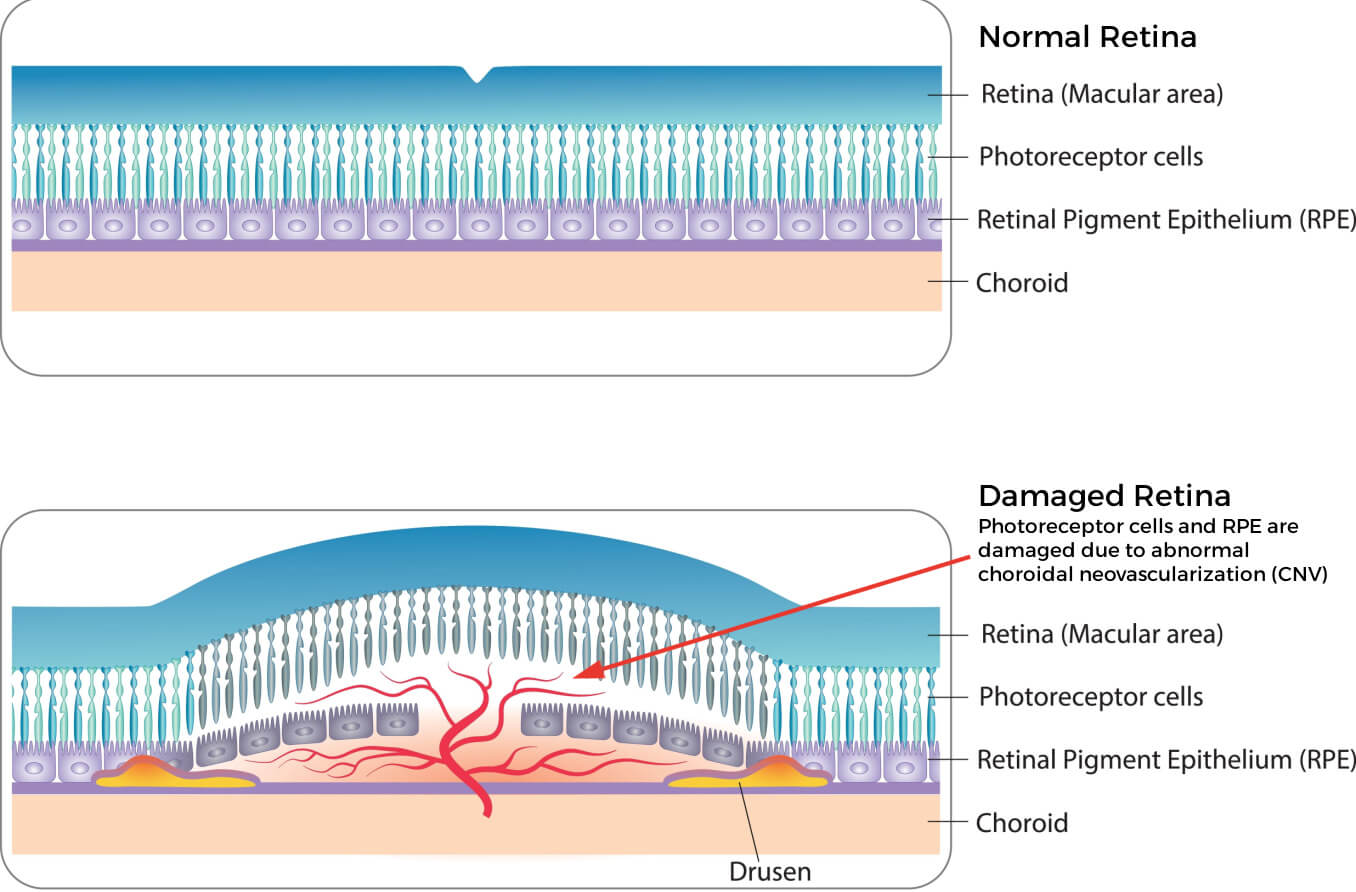 CNVM Choroidal Neovascular Membrane A Detailed Explanation, 43% OFF