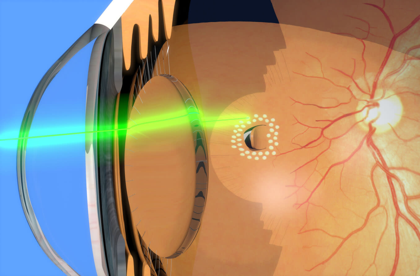 Depiction of laser photocoagulation around retinal tear