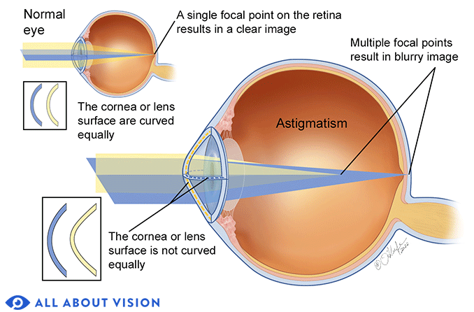 astigmatism eye