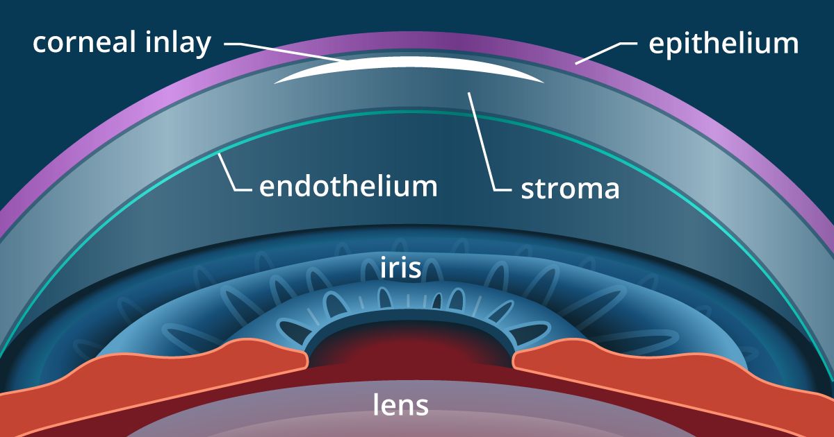 eye with corneal inlay for presbyopia
