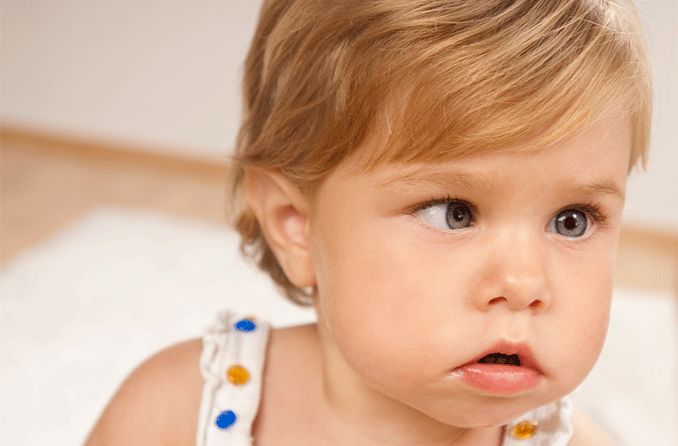 toddler with esotropia (crossed eyes)