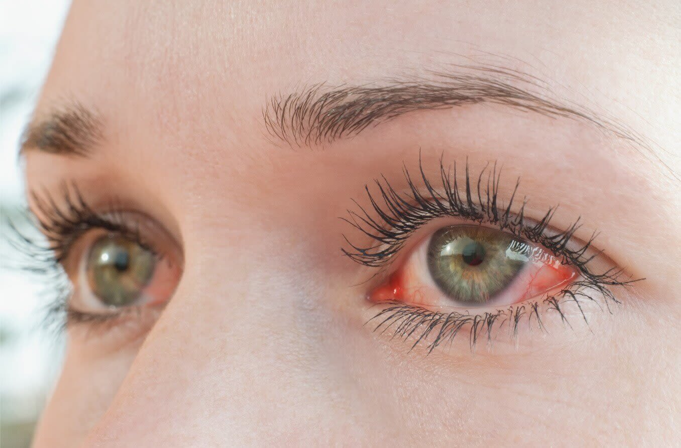 Eyes with symptoms of photokeratitis
