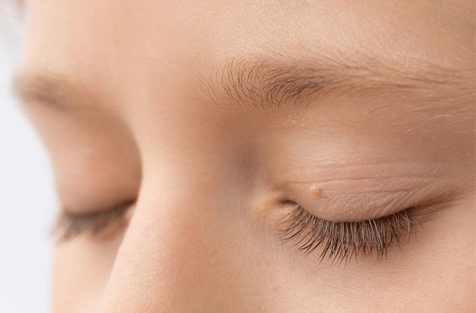closeup of an eyelid skin tag