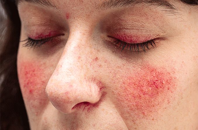 woman with eyelid dermatitis