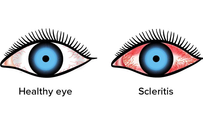 illustration of an eye with scleritis