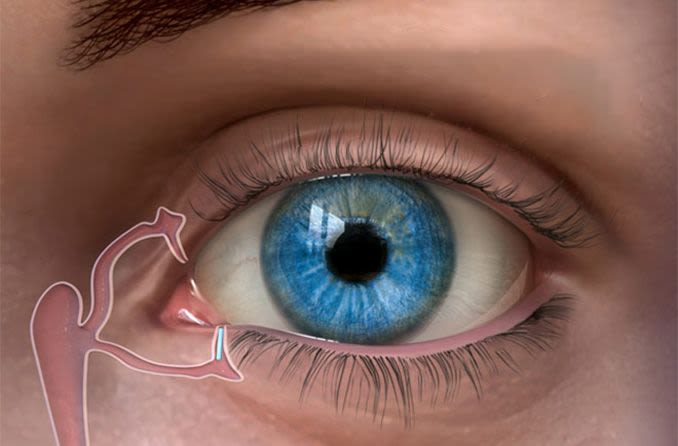 ilustración de un tapón punctal en un ojo