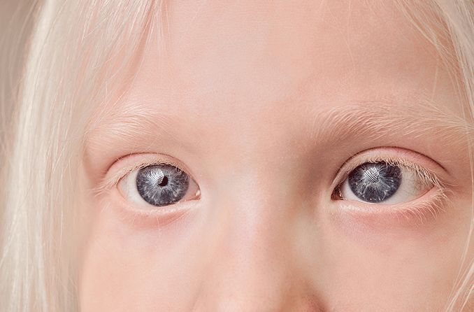 young girl's eyes with ocular albinism