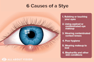 Reasons Why You Get A Stye What Is A Stye Plus Eye Stye Causes And 