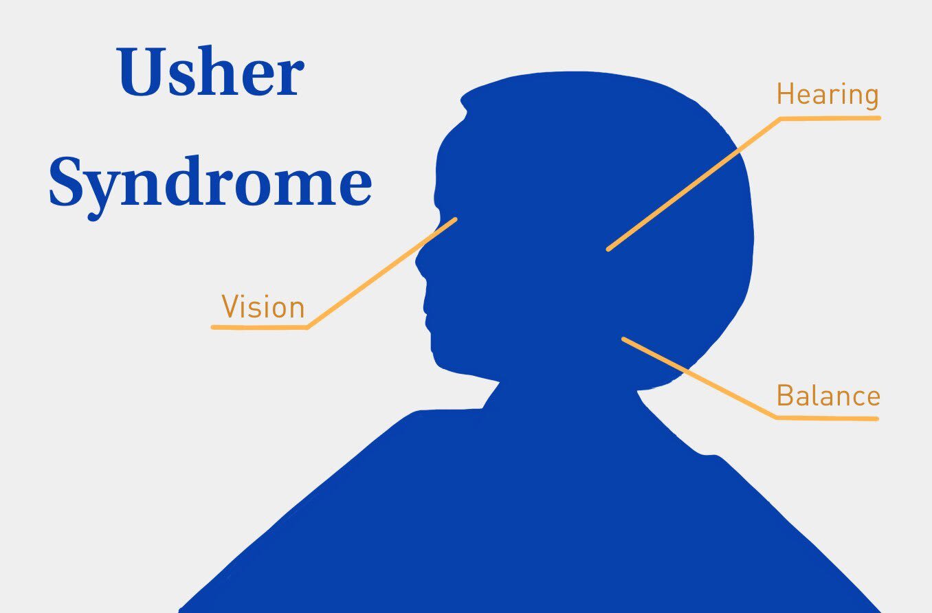 Usher syndrome can affect hearing, vision, and balance.