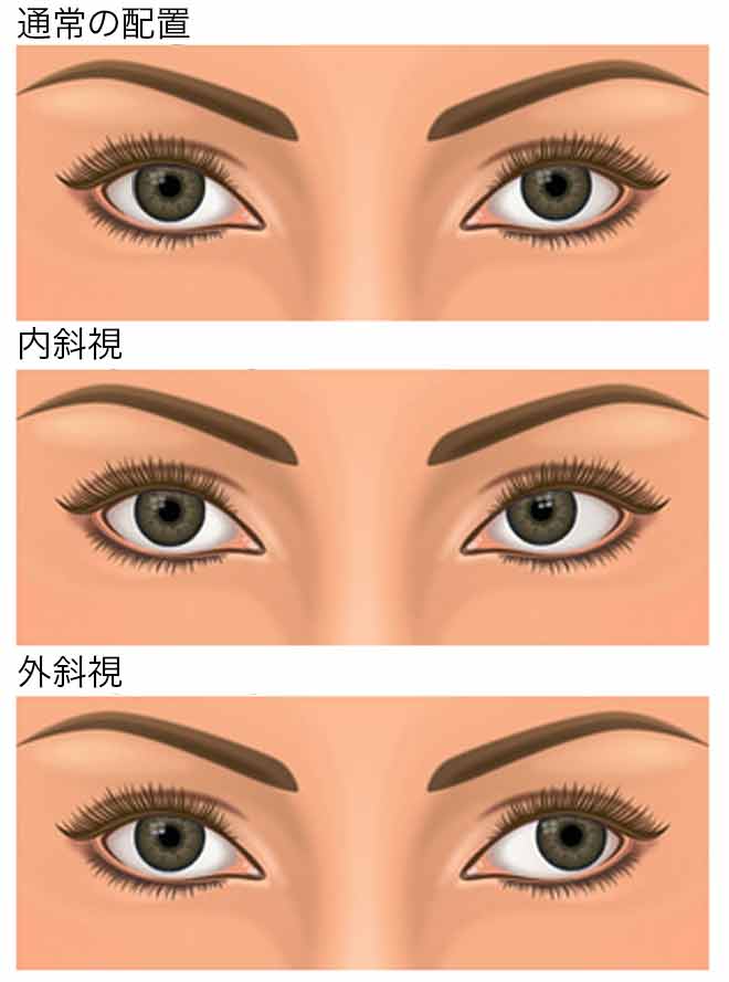 斜視（寄り目）：原因と対応