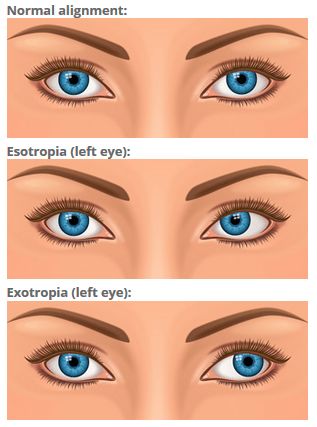 Cross Eyed, Eye Care