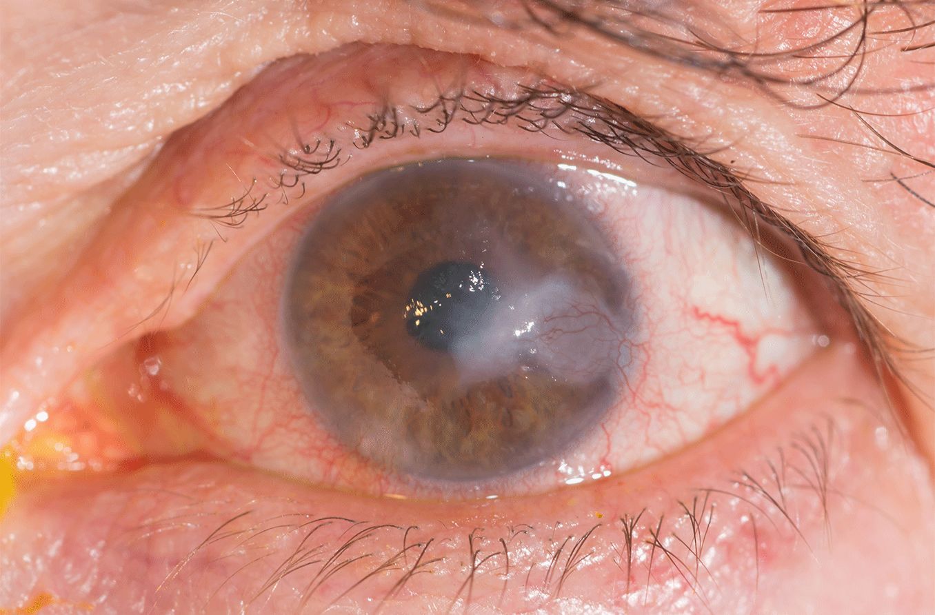 close up of and eye with interstitial keratitis and corneal infiltrates during an eye exam