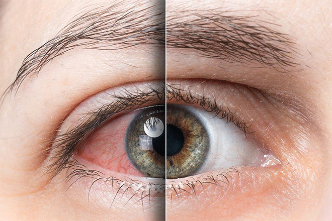 Causes And Treatment For Bloodshot Eyes